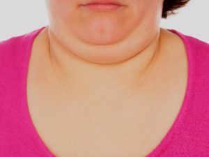 Double-Chin-Removal-